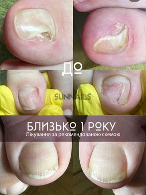 Eco Grit F-CREAM Fungus Remedy, 30 мл &mdash; фунгіцидний крем від грибка, 30 мл