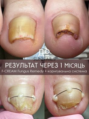 Eco Grit F-CREAM Fungus Remedy, 30 мл &mdash; фунгіцидний крем від грибка, 30 мл