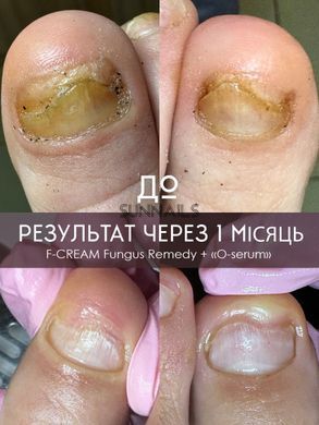 Eco Grit F-CREAM Fungus Remedy, 30 мл &mdash; фунгіцидний крем від грибка, 30 мл