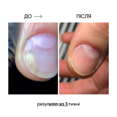 NAILSOFTHEDAY Onistop, 15 мл — регенеруюча олія проти оніхолізису