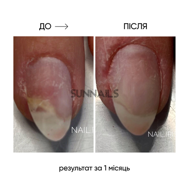 NAILSOFTHEDAY Onistop, 15 мл &mdash; регенеруюча олія проти оніхолізису