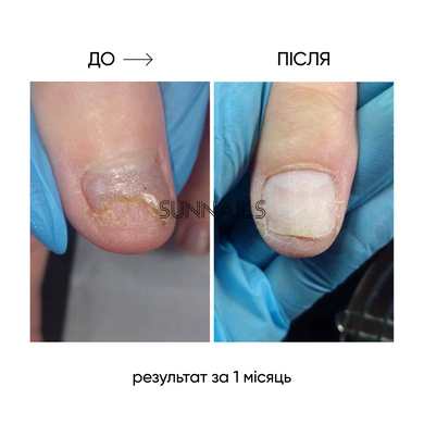 NAILSOFTHEDAY Onistop, 15 мл &mdash; регенеруюча олія проти оніхолізису