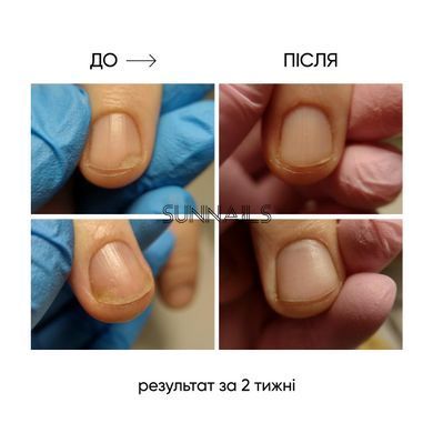 NAILSOFTHEDAY Onistop, 15 мл &mdash; регенеруюча олія проти оніхолізису
