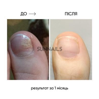 NAILSOFTHEDAY Onistop, 8 мл &mdash; регенеруюча олія проти оніхолізису